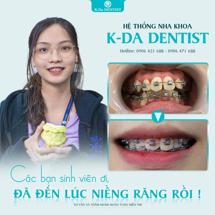 Hình ảnh quy trình niềng răng chuẩn y khoa tại Nha Khoa Quốc Tế K-Da