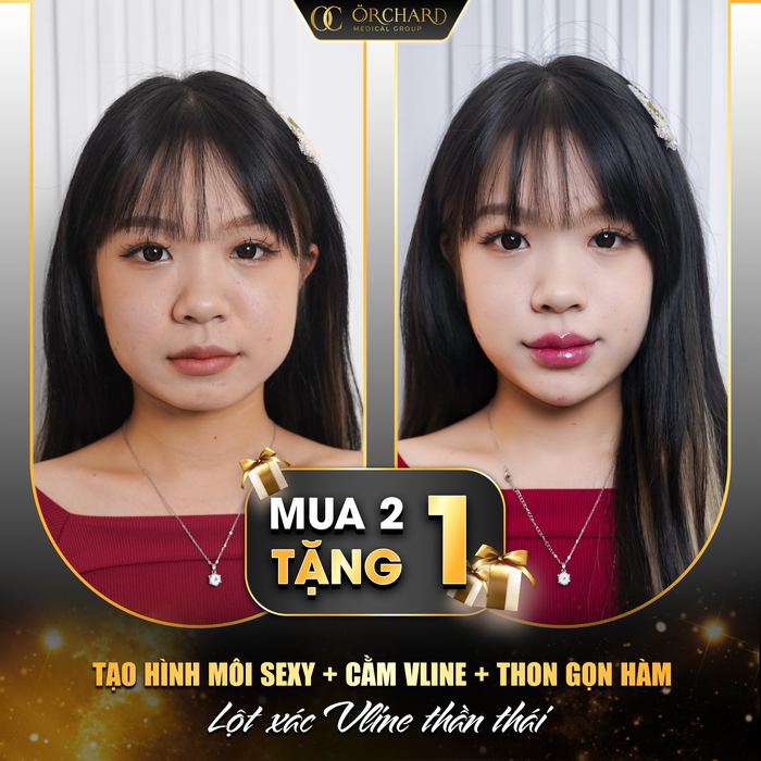 Quy trình tiêm filler chuẩn y khoa tại Orchard Group