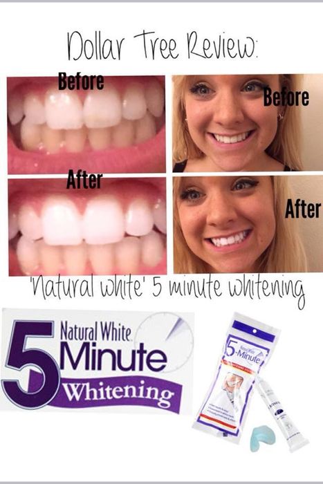 Hình ảnh minh họa - Gel Natural White đang tác động làm trắng răng