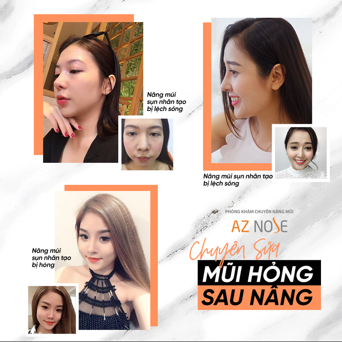 Hình ảnh 2 của AZ NOSE - Trung Tâm Nâng Mũi