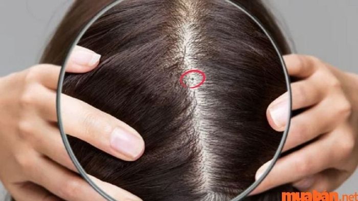 Nốt ruồi ở giữa đỉnh đầu mang ý nghĩa gì?