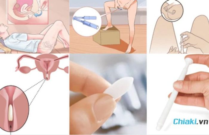 Cách sử dụng viên đặt phụ khoa trị nấm ngứa 