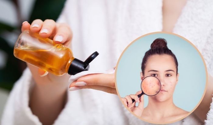 Toner chứa thành phần kháng khuẩn giúp ngăn ngừa viêm nang mụn