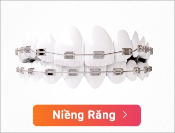 Niềng răng