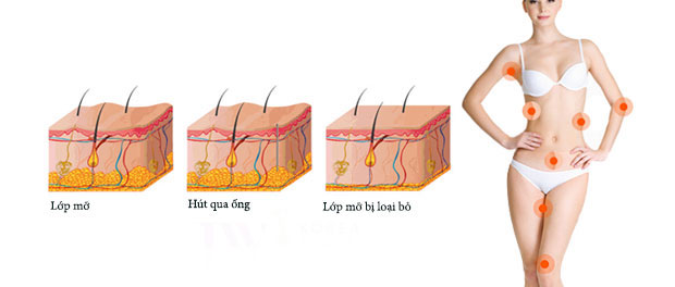 Hút mỡ toàn thân