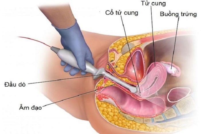 Tìm hiểu về siêu âm đầu dò