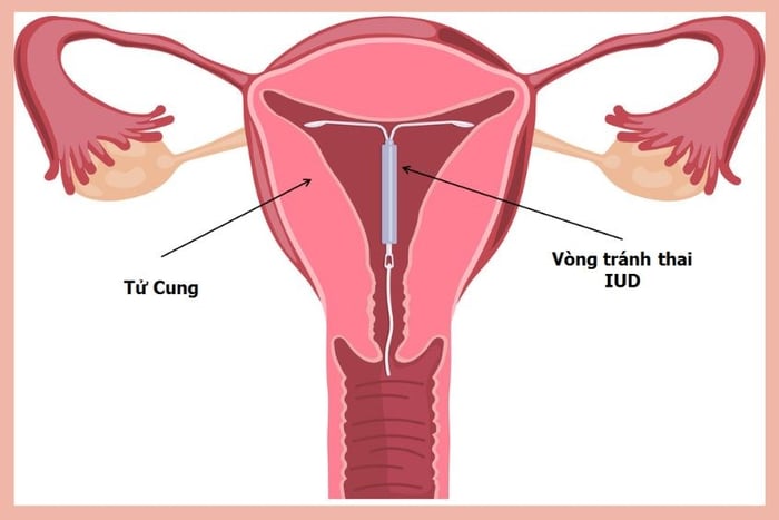 Hãy đặt vòng tránh thai ngay