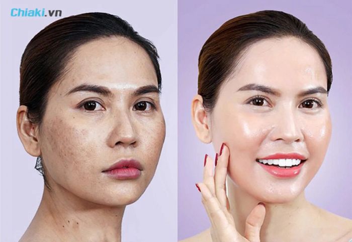 Ưu nhược điểm của phương pháp cấy trắng da mặt