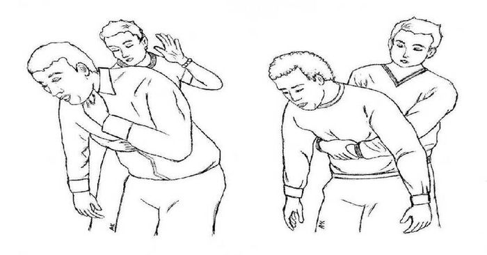 Áp dụng phương pháp Heimlich để sơ cứu người bị dị vật đường thở
