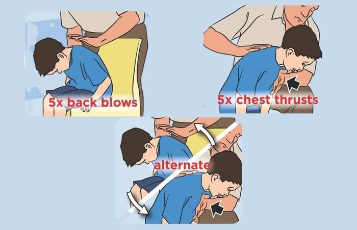 Phương pháp sơ cứu cho trẻ lớn hơn và trẻ vị thành niên. Ảnh: Facebook bác sĩ Huyên Thảo