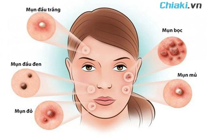 Top 22 Acne Serum tốt nhất hiện nay được các bác sĩ khuyên dùng