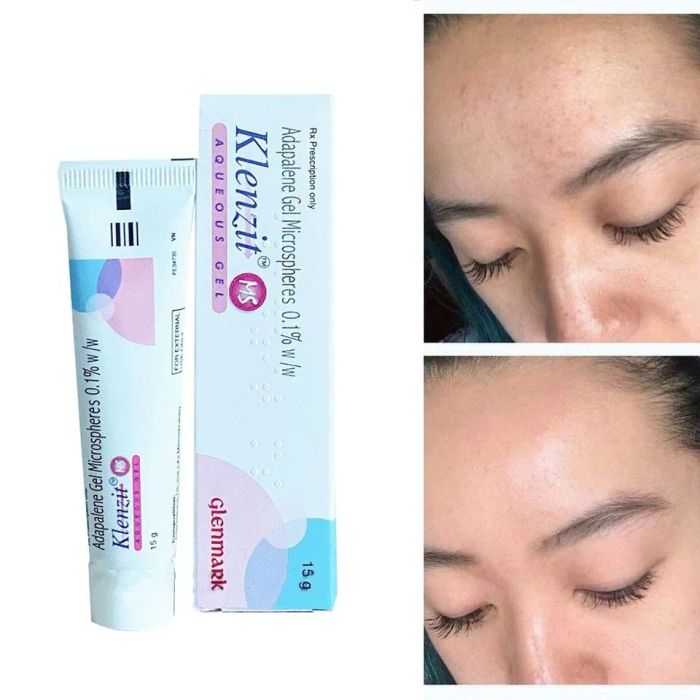 Gel Klenzit MS Hỗ Trợ Giảm Mụn Trứng Cá và Mụn Ẩn