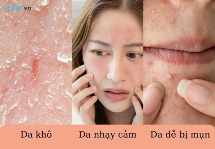 Những người có làn da khô, nhạy cảm, dễ mụn nên tẩy trang hàng ngày để bảo vệ da