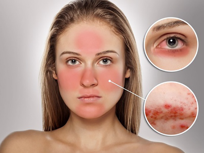 Cấy collagen tươi có gây tác dụng phụ không?