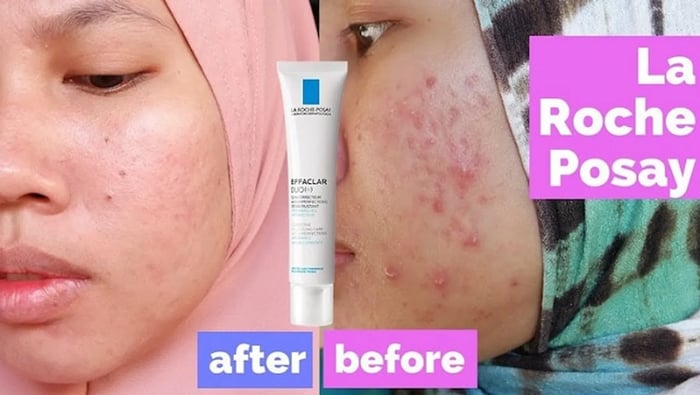 La Roche Posay Duo+ có đẩy mụn không