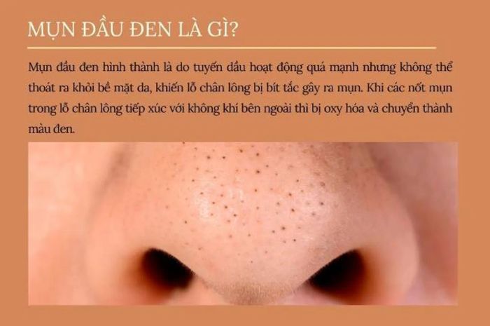 Mụn đầu đen có thể khiến da bạn trở nên tối màu hoặc không khỏe mạnh