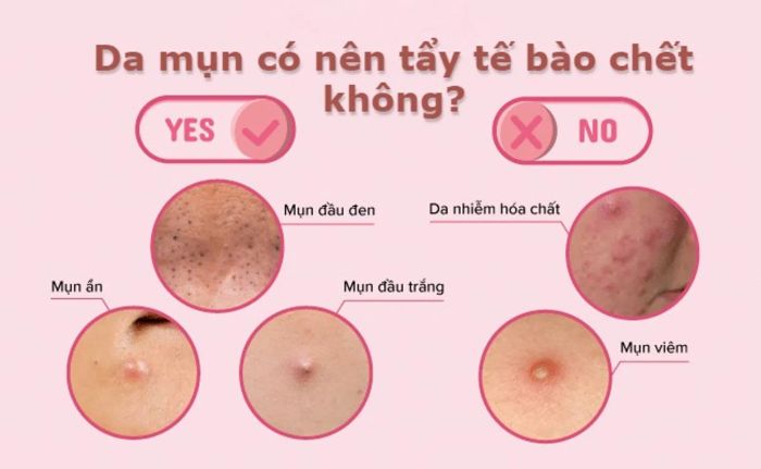 Khi nào nên và không nên tẩy tế bào chết cho da mụn?