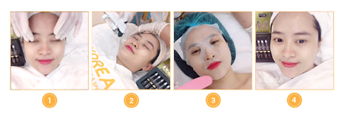 Quy trình thực hiện cấy collagen tươi