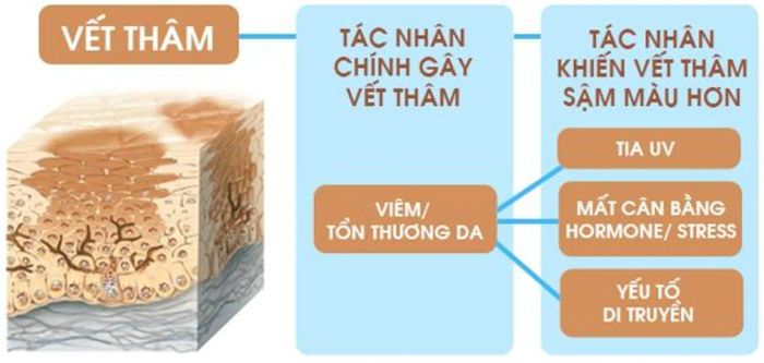 Nguyên nhân gây ra thâm mụn là do sự giải phóng melanin dư thừa ở vùng da bị tác động