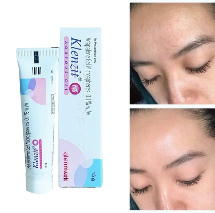 Klenzit MS có trị mụn ẩn không