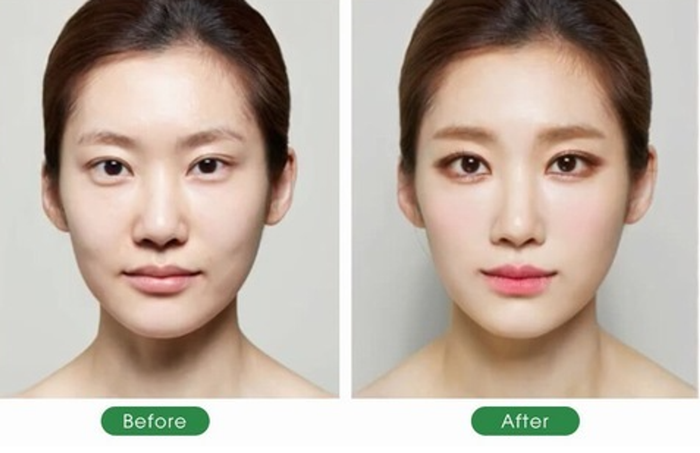 Cấy collagen tươi duy trì được bao lâu