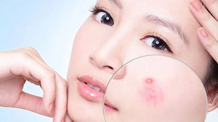 Uống collagen có gây nổi mụn không? Có gây nóng không?