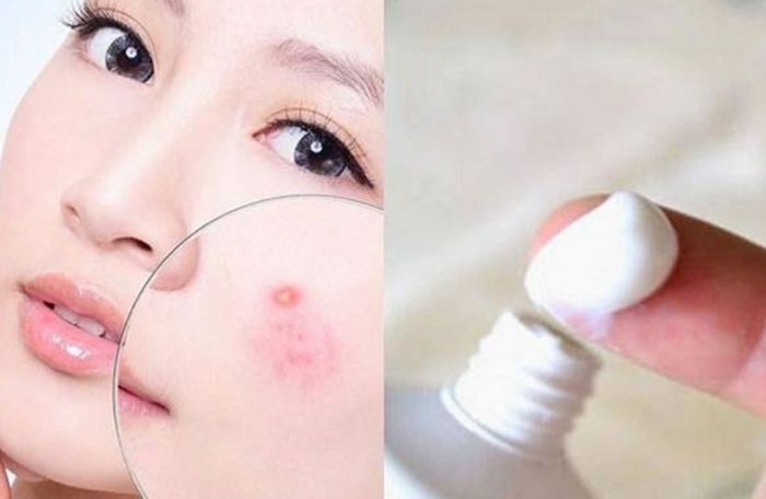 Cách sử dụng benzoyl peroxide