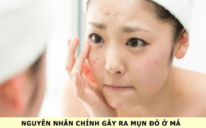 Mụn viêm đỏ không nhân trên má có nguồn gốc từ nhiều nguyên nhân khác nhau