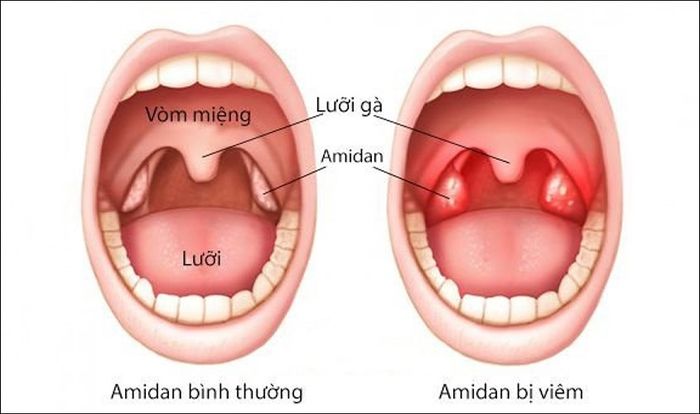 Quy trình phẫu thuật cắt họng cho trẻ