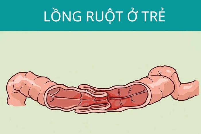 Hiện tượng bé bị lồng ruột là gì