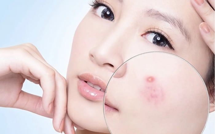 Salicylic acid phù hợp cho da dầu mụn