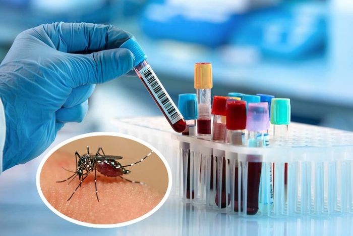 Xét nghiệm sốt xuất huyết giúp xác định có hiện diện của virus gây bệnh