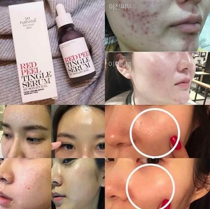 Sử dụng Red Peel gây phát sinh mụn do tác dụng đẩy mụn ẩn