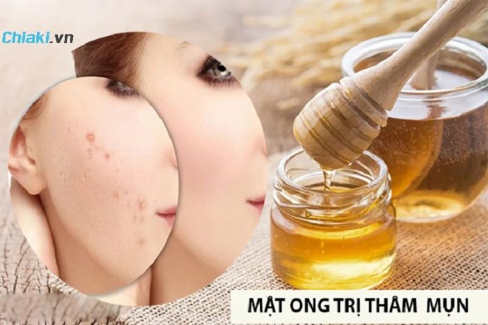 Cách trị mụn tại nhà hiệu quả sau 1 đêm khi thoa mật ong