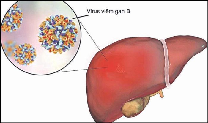 Viêm gan ở trẻ em có thể dẫn đến các bệnh nguy hiểm