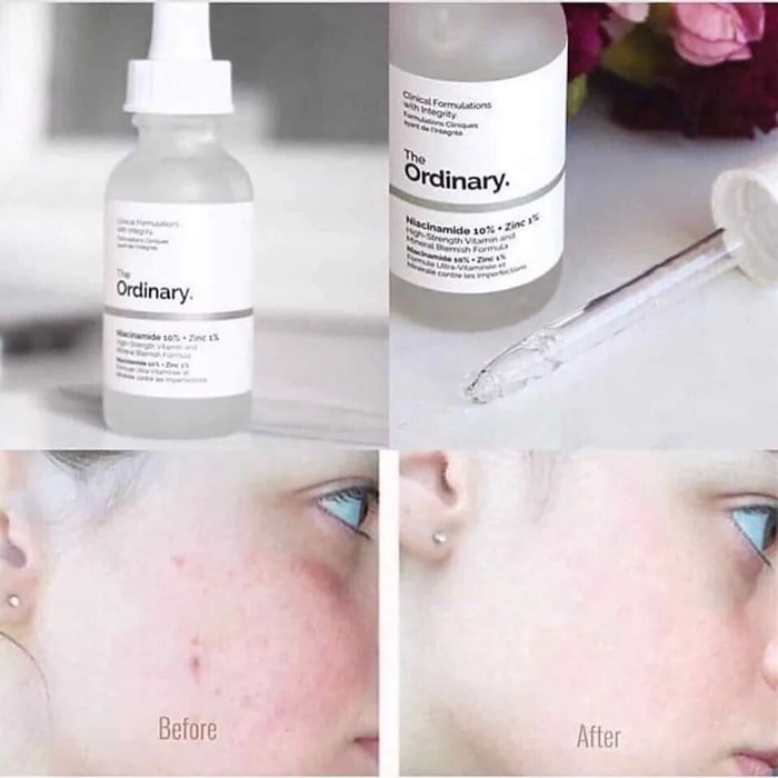 Serum The Ordinary Niacinamide 10% + Zinc 1% chống viêm