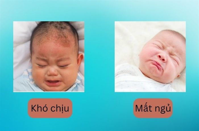 Trẻ sơ sinh mắc phải tình trạng viêm da tiết bã nhờn