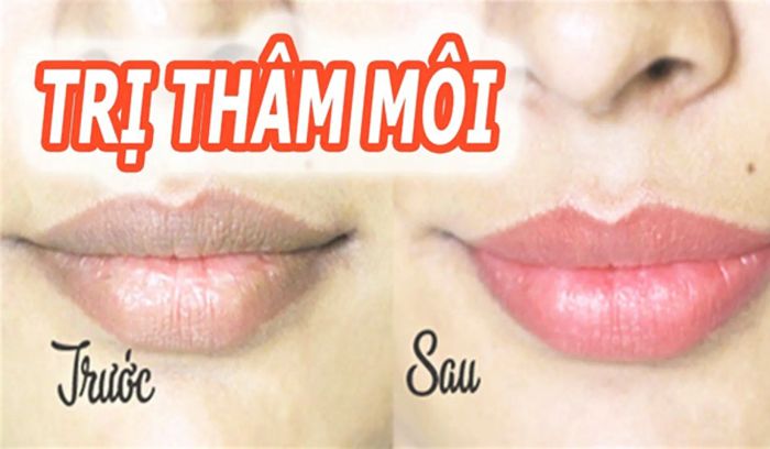 15 phương pháp trị thâm môi tại nhà nhanh chóng chỉ trong 1 tuần