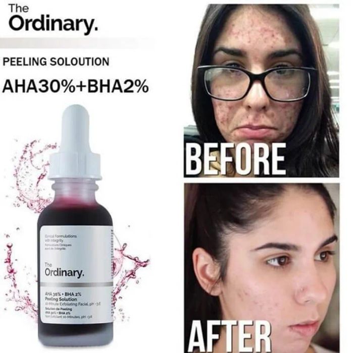 Công dụng của Serum The Ordinary AHA 30% + BHA 2% Peeling Solution