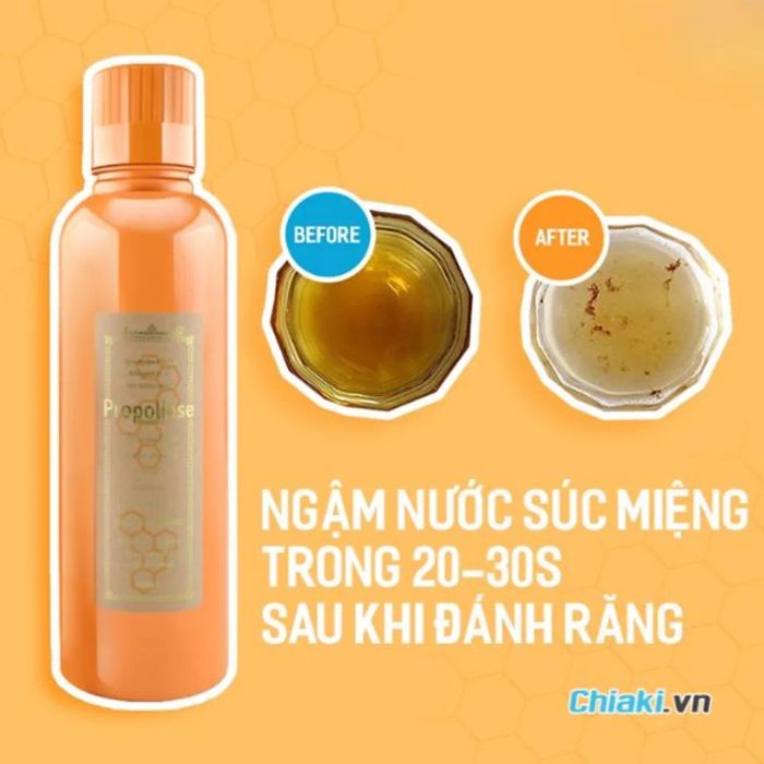 Nước súc miệng Propolinse cho người đang niềng răng.