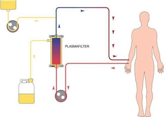 Sử dụng phương pháp plasmapheresis cho trẻ. Nguồn từ childkidneycare