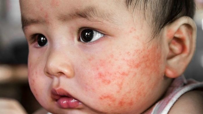 Bệnh PKU có thể gây ra eczema ở trẻ