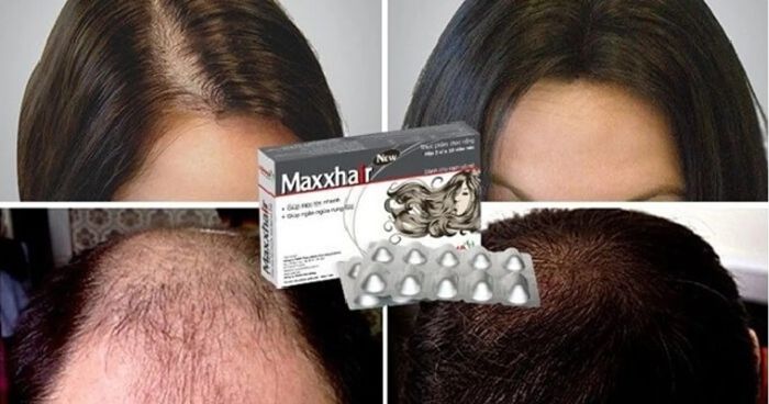 Maxxhair có thực sự hỗ trợ mọc tóc và giảm rụng tóc không?