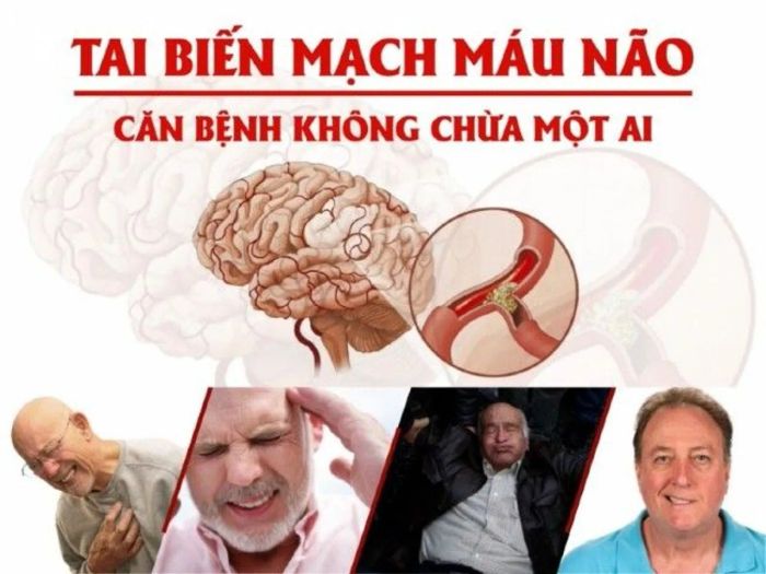 Đột quỵ là gì và làm thế nào để phòng tránh?