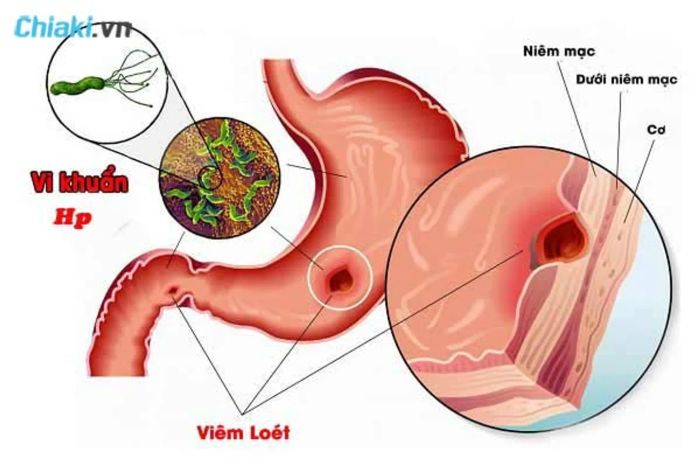 Fucoidan ngăn chặn vi khuẩn HP xâm nhập