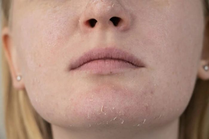 Tình Trạng Da Khô với Đặc Điểm Vảy Khô