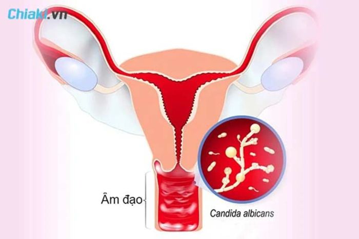 Tình trạng nhiễm nấm Candida âm đạo