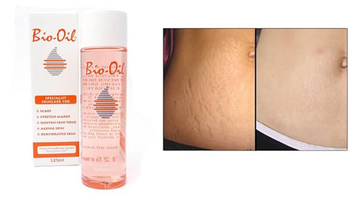 Tinh dầu Bio Oil giúp làm mờ vết sẹo và rạn da