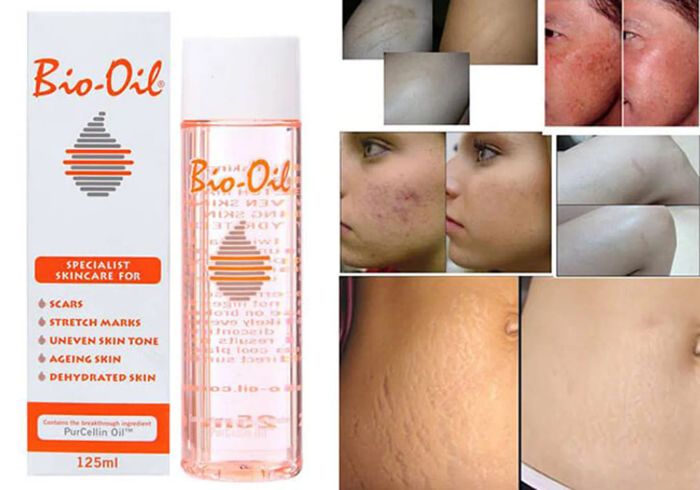 Tinh dầu trị rạn da Bio Oil chính hãng