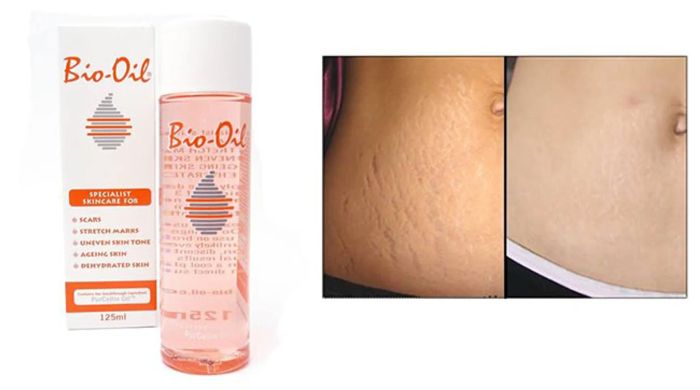 Cách trị rạn da cho bà bầu hiệu quả nhất với Bio Oil